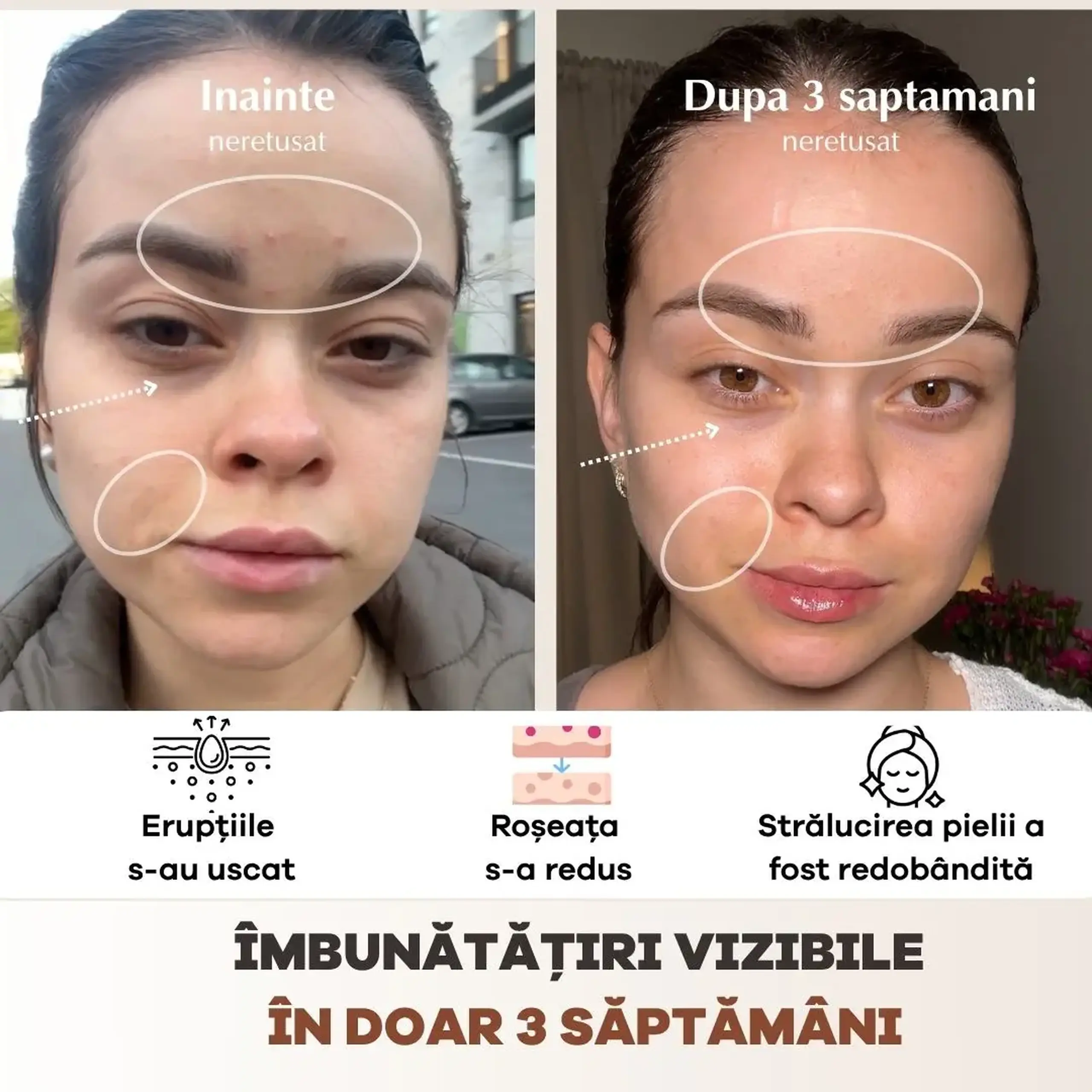 Masca faciala LED Wireless Me Time Ritual, 3 moduri de lumina (rosie, albastra, infrarosie), anti-acnee, anti-riduri, stimulare colagen, din silicon medical